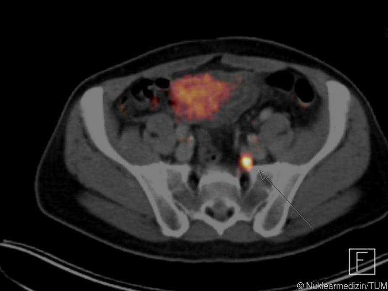 Neue Methode zeigt die kleinsten Metastasen beim Prostatakrebs