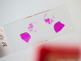 Neuer Signalweg der Leukämie entdeckt, könnte neue Behandlungsoptionen eröffnen