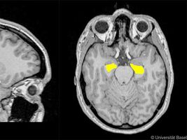 Schizophrenie-Entstehung hängt mit dem Volumen des Hippocampus zusammen