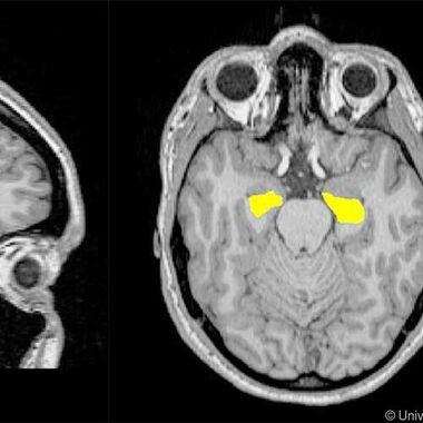 Schizophrenie-Entstehung hängt mit dem Volumen des Hippocampus zusammen