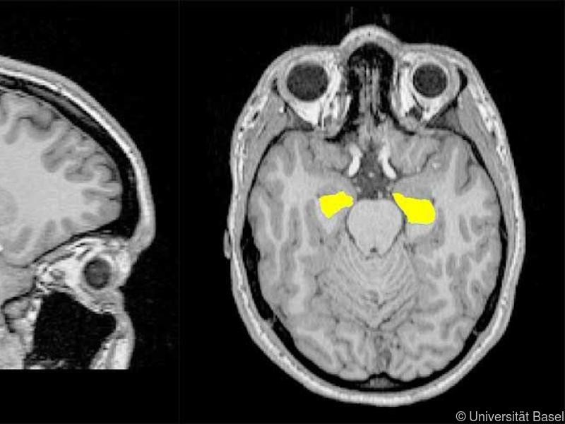 Schizophrenie-Entstehung hängt mit dem Volumen des Hippocampus zusammen