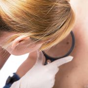 Hautkrebs-Kongress: Auf dem Weg zu neuen Melanom-Therapien bei BRAF-Mutation
