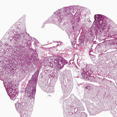 Pneumokokken besonders gefährlich, wenn Grippeviren schon da sind
