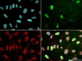 Therapieresistentes Prostatakarzinom kann an einem Biomarker erkannt werden