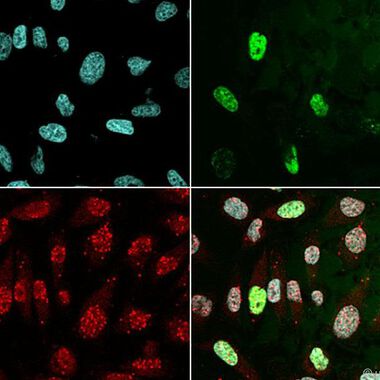 Therapieresistentes Prostatakarzinom kann an einem Biomarker erkannt werden