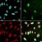 Therapieresistentes Prostatakarzinom kann an einem Biomarker erkannt werden