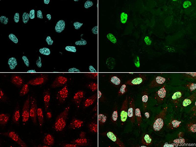 Therapieresistentes Prostatakarzinom kann an einem Biomarker erkannt werden