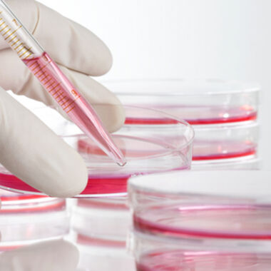 Neue Einblicke in das großzellige anaplastische Lymphom