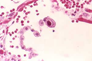 Neue Erkenntnisse über Reaktionen des Immunsystems gegen Cytomegalovirus