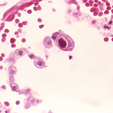 Neue Erkenntnisse über Reaktionen des Immunsystems gegen Cytomegalovirus