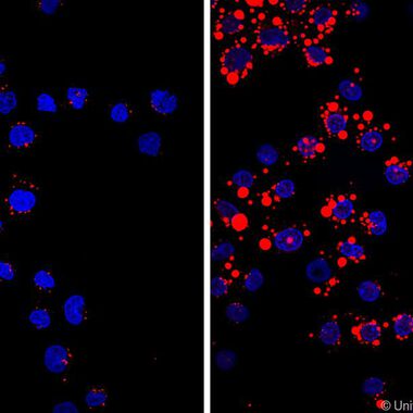 Neues Detail wie Immunzellen zur Arteriosklerose beitragen