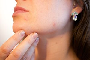 Das Phänomen Microneedling