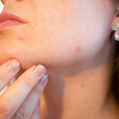 Das Phänomen Microneedling