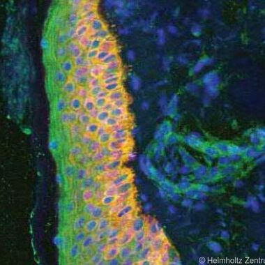 Antikörper hemmt auch "guten" Botenstoff bei Psoriasis