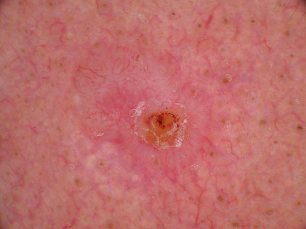 Basalzellkarzinom dermatologisch