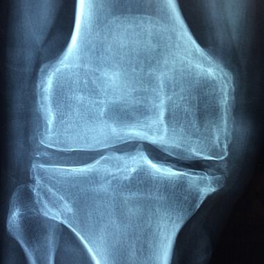 Vitamin D gegen Knochenschwund