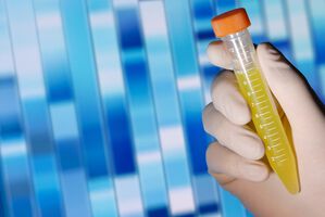 Neuer Biomarker für AML gefunden