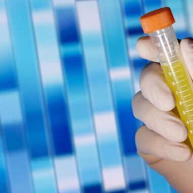 Neuer Biomarker für AML gefunden