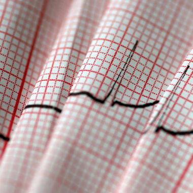 Dialysepatienten leiden häufiger an Vorhofflimmern als vermutet