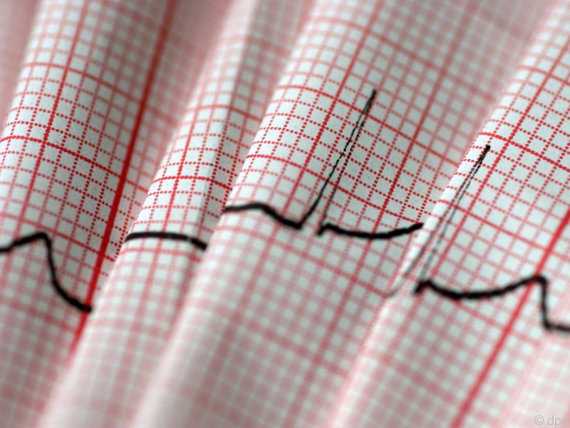 Dialysepatienten leiden häufiger an Vorhofflimmern als vermutet