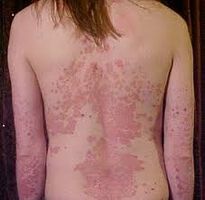 Botenstoff des Immunsystems neutralisiert Schuppenflechte-Symptome
