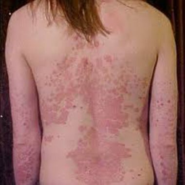 Botenstoff des Immunsystems neutralisiert Schuppenflechte-Symptome