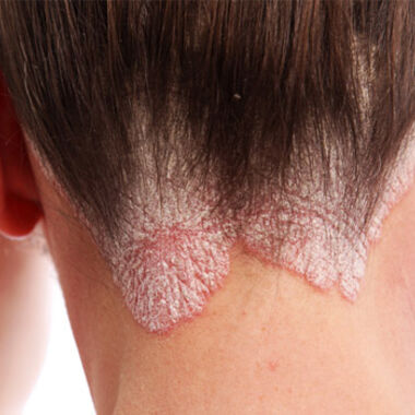 87 Prozent der heimischen Psoriasis-Patienten erleben Diskriminierung