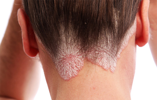 87 Prozent der heimischen Psoriasis-Patienten erleben Diskriminierung
