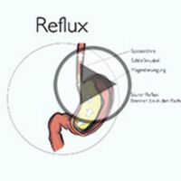 Reflux oder Sodbrennen