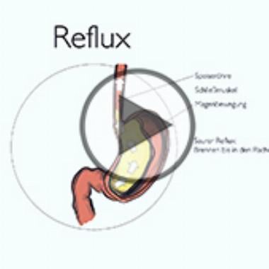 Reflux oder Sodbrennen