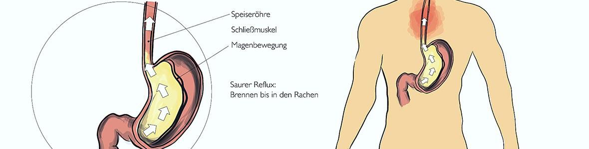 Reflux oder Sodbrennen