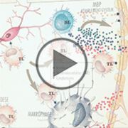 Symptome und Therapiemöglichkeiten von Multiple Sklerose - Video