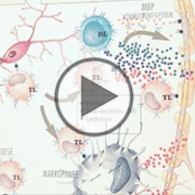 Symptome und Therapiemöglichkeiten von Multiple Sklerose - Video