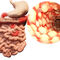 Morbus Crohn