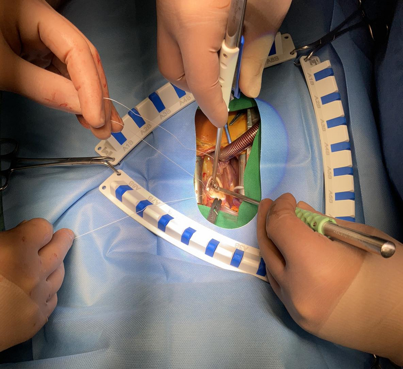 КАРДИОХИРУРГИЯ: Аортно клапно протезиране с горна парциална стернотомия thumb image