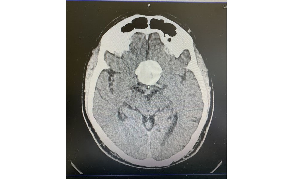 ОЧНИ БОЛЕСТИ: Тумор в мозъка, открит след офталмологичен преглед thumb image