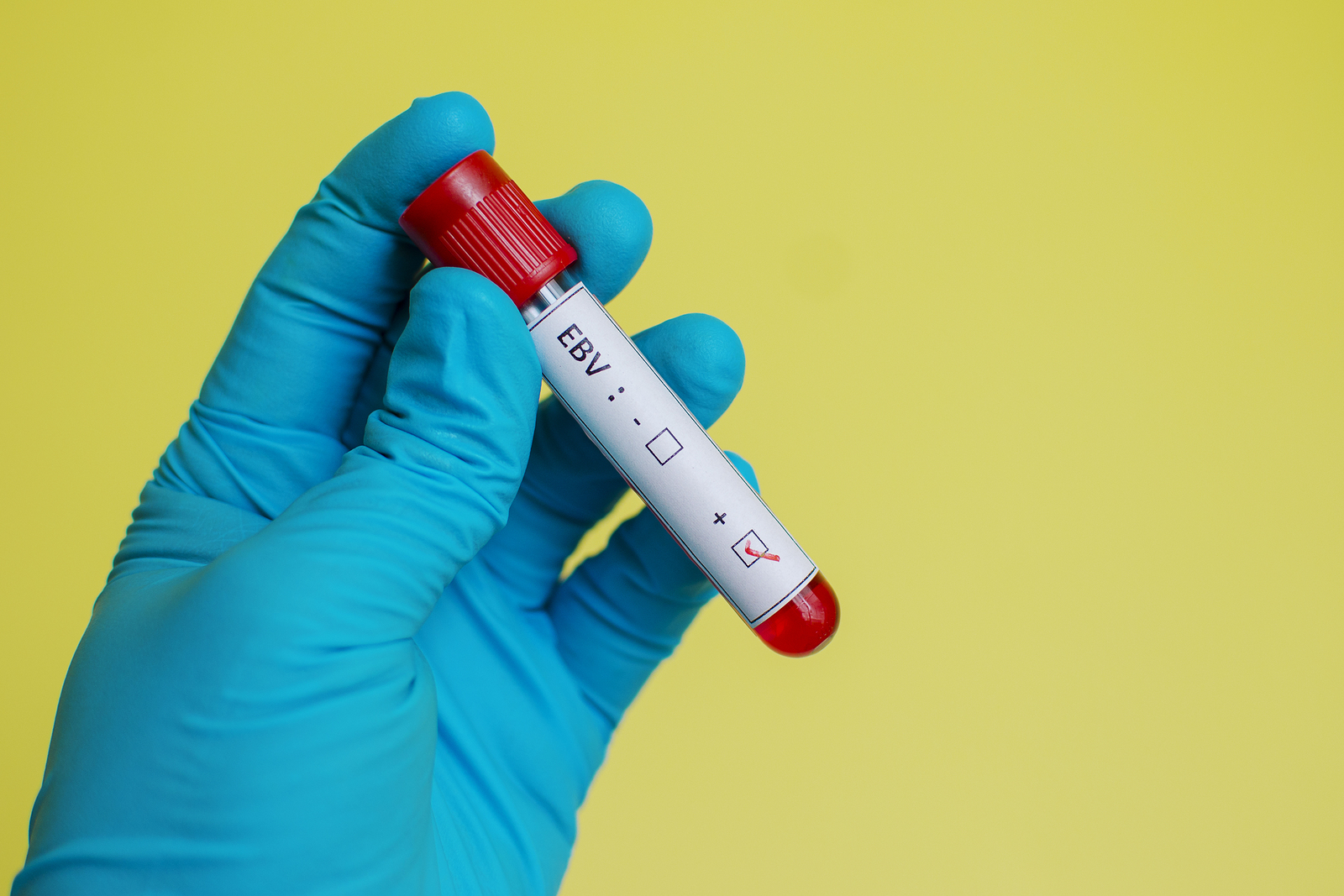 Имунотерапия при инфекция с Epstein-Barr virus започваща като неясно фебрилно състояние