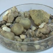 Нелекуваните камъни в бъбреците са риск за инвалидизация