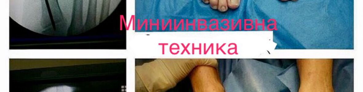 Нов миниинвазивен метод за лечение на кокалче на краката премахва проблема за 15 мин!