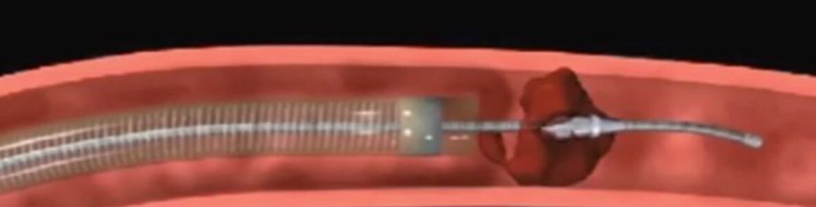 Отстраняването на съсирек при инсулт е ефективно в първите 6 часа (Видео)