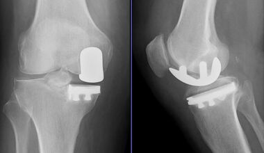 Ревизионно ендопротезиране: смяна на износена колянна става със съпътстващи  тежки костни дефекти и нестабилност 