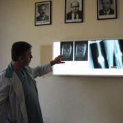 В УМБАЛ "Св. Георги" спасиха крака на жена със специална протеза