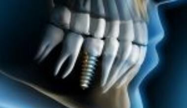 УМБАЛ „Св. Анна“ вече ще предлага цялостно имплантологично лечение