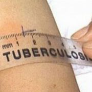 СЕДМИЦА НА ОТВОРЕНИТЕ ВРАТИ ЗА ПРЕВЕНЦИЯ И КОНТРОЛ НА ТУБЕРКУЛОЗАТА