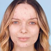 Жени с акне пускат селфита без грим в кампания за толерантност