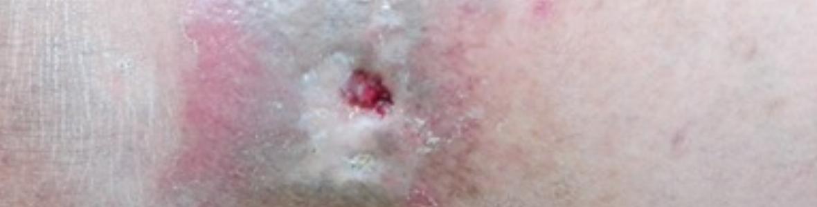 Безплатни консултации за пациенти с трудно зарастващи рани