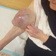 92-годишна пациентка с рядък тумор е оперирана успешно в УМБАЛ Бургас