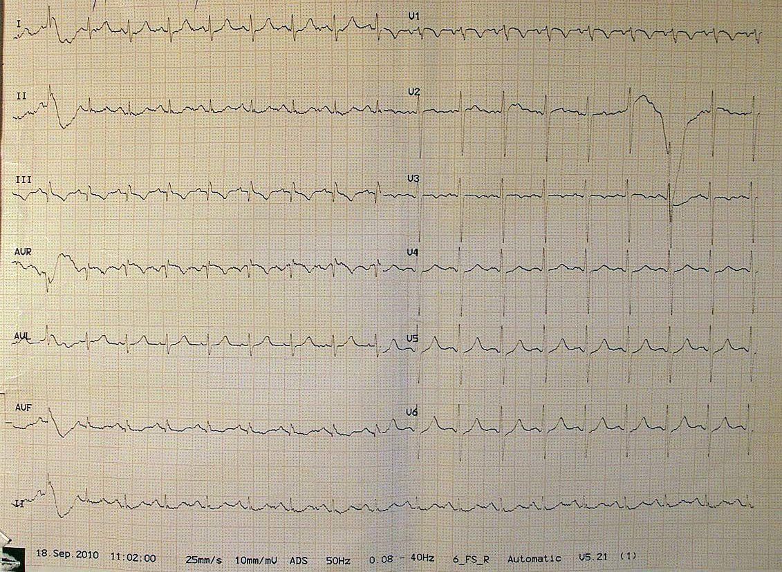 submassive pulmonary embolism