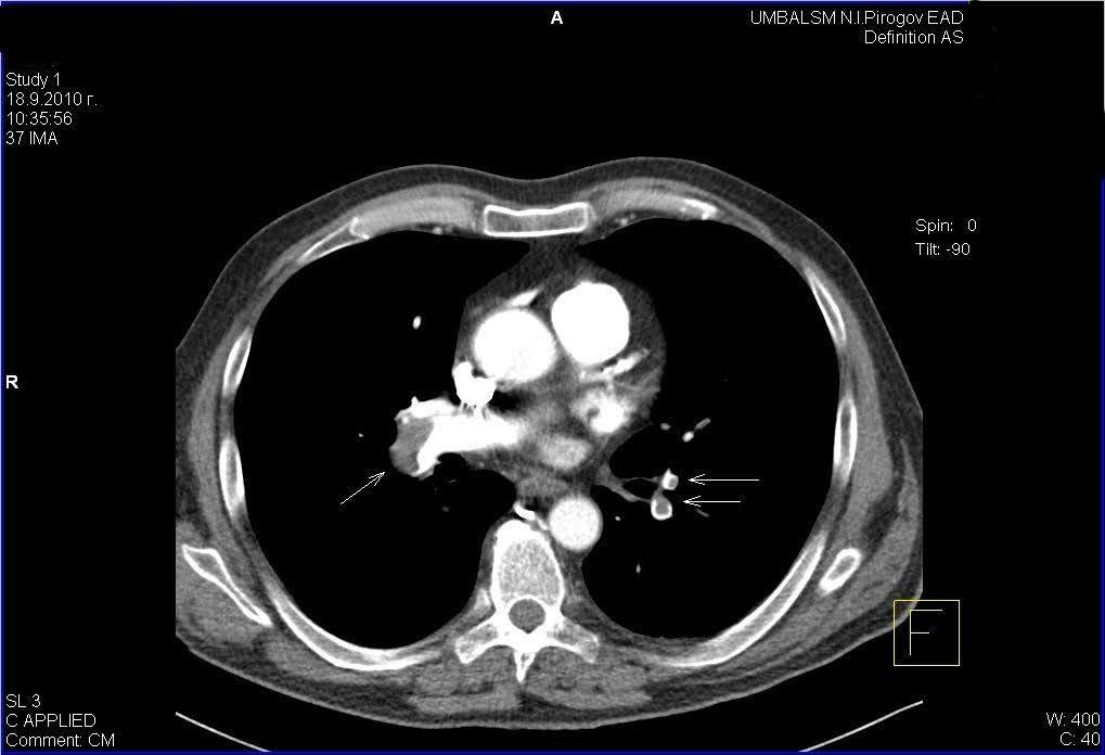 submassive pulmonary embolism