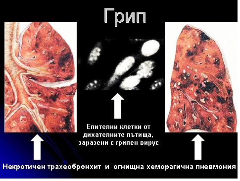 ГРИП - ОБЩА ХАРАКТЕРИСТИКА И ВИРУСОЛОГИЧНА ДИАГНОСТИКА